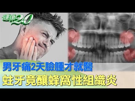 牙痛臉腫怎麼消|牙痛臉腫多久會消？牙痛成因、消腫方式看這篇！